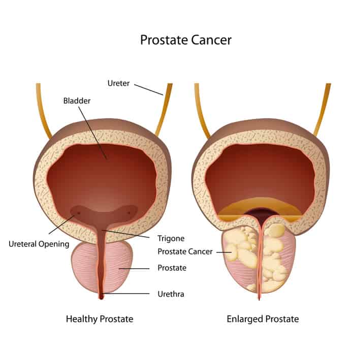 Prostate Cancer