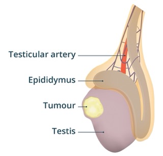 Testicular Cancer